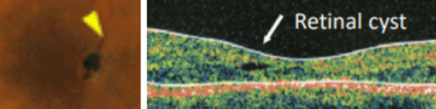 <p>group of IJFTs that are bilateral with more subtle telangiectasias occurring primarily in middle aged (>50 yo) patients and causing vision loss due to retinal atrophy. CNVM is common. Is associated with systemic disease (DM, HTN, CVD).</p>