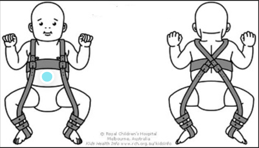 <p>soft, dynamic splint<strong> </strong>commonly used to treat DDH in infants under 6 months; worn 23 hours/day; holds the hips in a stable, flexed, and abducted position, to allow for proper hip joint development</p>