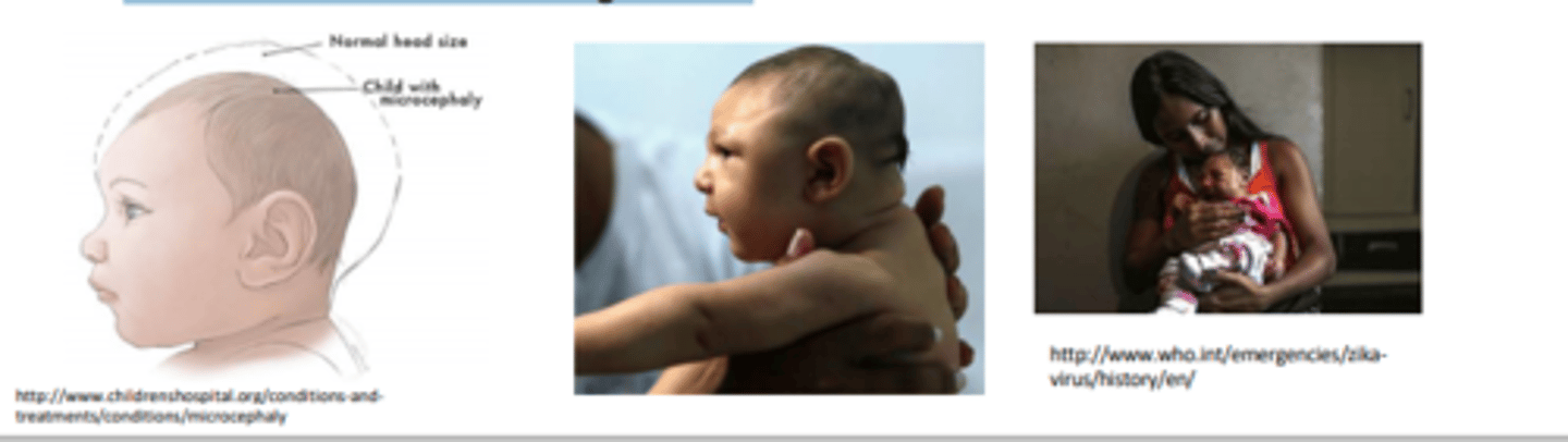 <p>Microcephaly is a neonatal malformation defined as head size much smaller than</p><p>other babies of the same age and sex</p><p>A very rare condition; most common known causes are</p><p>• infection in-utero with toxoplasmosis, rubella, herpes, syphilis, HIV, CMV</p><p>• Exposure to toxic chemicals such as arsenic and mercury, alcohol</p><p>• Genetic abnormalities such as Down's syndrome</p><p>• Severe malnutrition during fetal life</p>