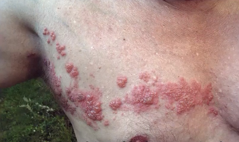 <p>-varicella-zoster; chickenpox; dorsal root ganglia</p><p>-dermatome</p><p>-doesn’t cross midline</p>