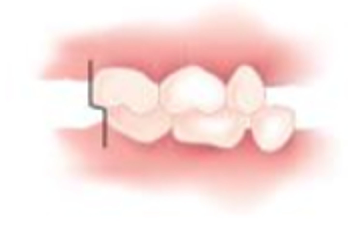 <p>may cause Class 1 occlusion</p>