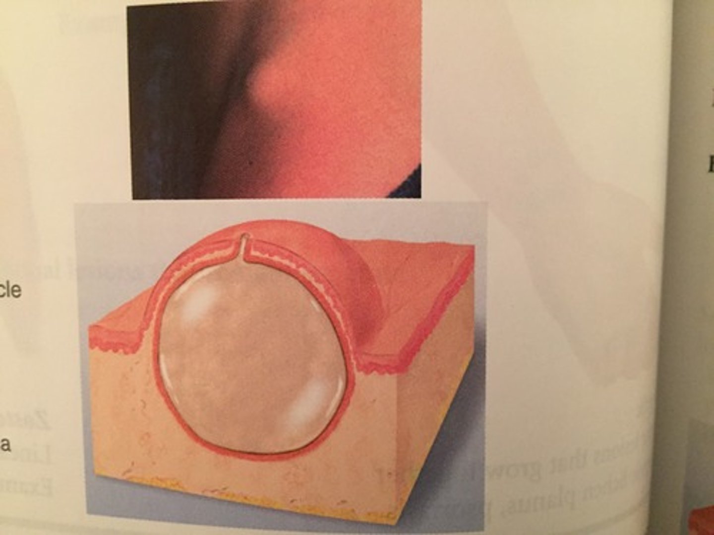 <p>Cyst</p>