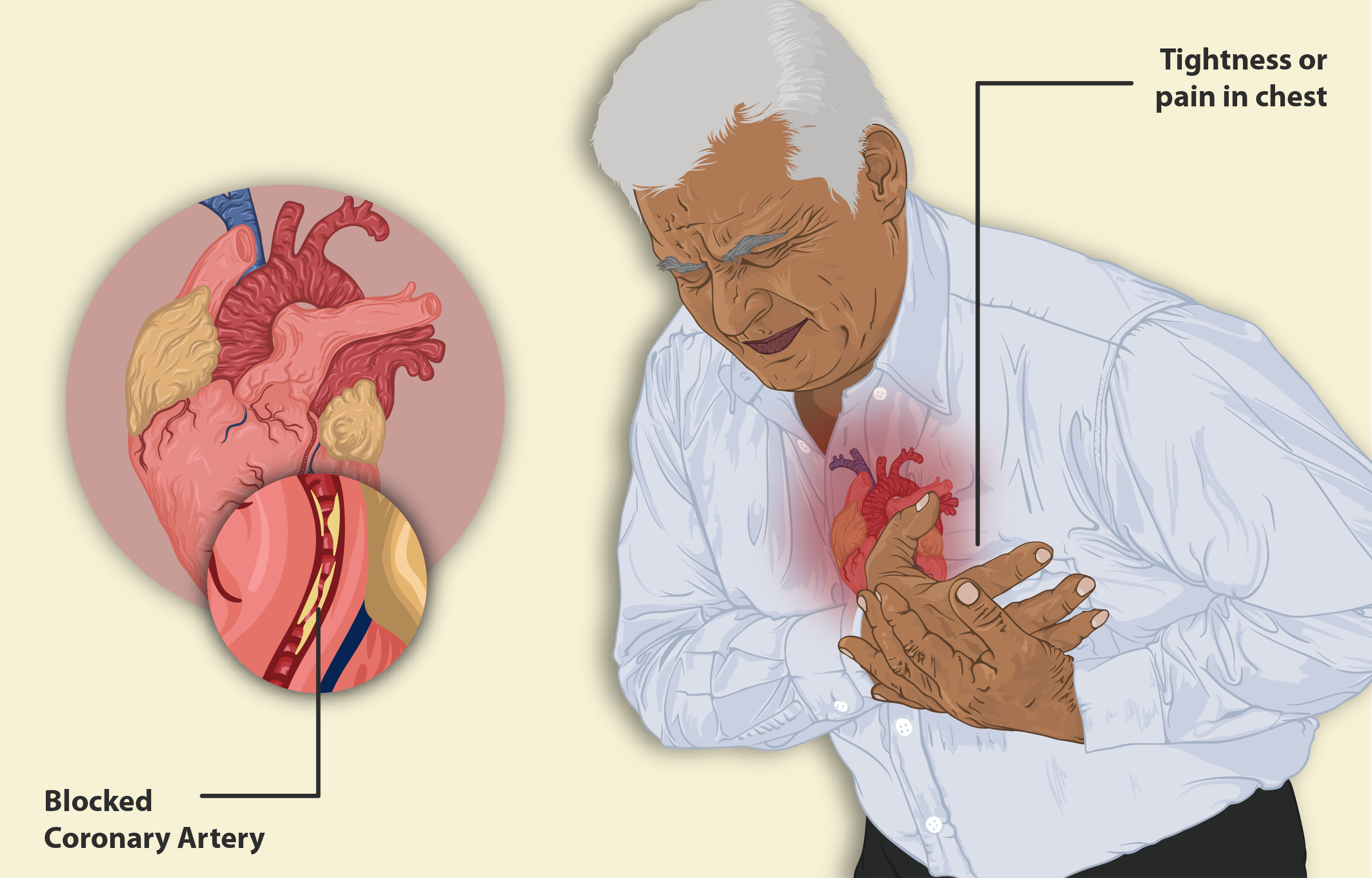 <p><span>chest pain or discomfort that happens when the heart doesn't get sufficient oxygen-rich blood</span></p>