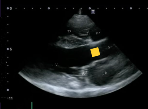 <p>Right parasternal 5 chamber view</p>