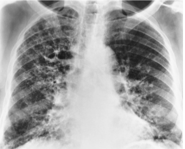 <p>Bronchiectasis </p>