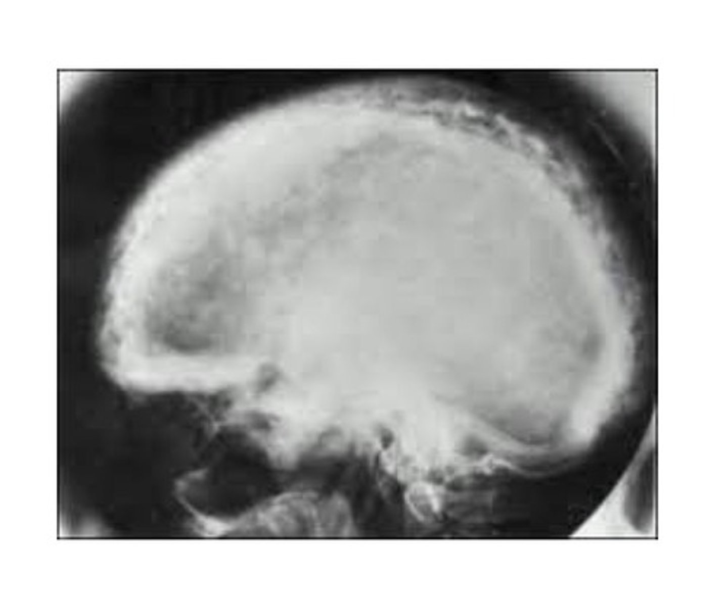 <p>A chronic metabolic bone disease. Characterized by resorption, osteoblastic repair, and remineralization of involved bone. Unknown cause, may be due to a virus. Most commonly occurs in men over age 50 yrs. Maxilla more commonly effected than mand. Enlargement of affected bone, pt often complains of pain, spaces may increase between teeth as jaw bone enlarges. Radiographic: a patchy and radiopacity, "cotton wool". Hypercementosis, loss of lamina dura, and obliteration of PDL may occur.</p>