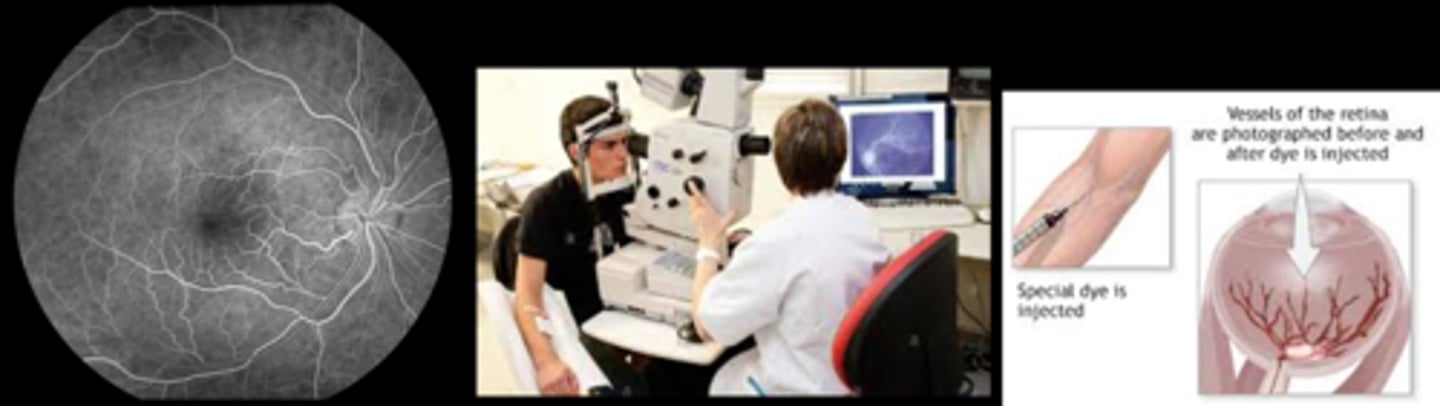 <p>abnormalities (which eye, location desired) as we cannot capture both eyes in early phase</p><p>ability to visualize retina = if we cannot see the retina on fundoscopy, we won't be able to see it on FA</p><p>fixation and cooperation ability = can they fixate for 10-20min? Rx?</p><p>non-invasive testing</p>