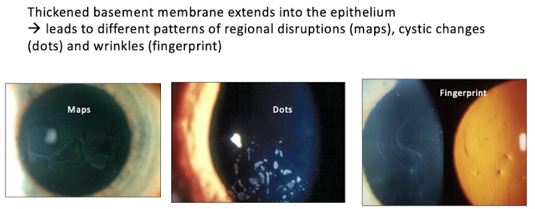 <p>thickened basement membrane extending into the epi</p>