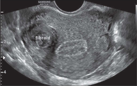 <ul><li><p>Heavy bleeding</p></li><li><p>pregnancy loss</p></li><li><p>Infertility</p></li><li><p>wha location is this?</p></li></ul><p></p>