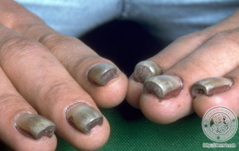 <p>a condition characterized by thickened nails, often associated with genetic disorders. </p>