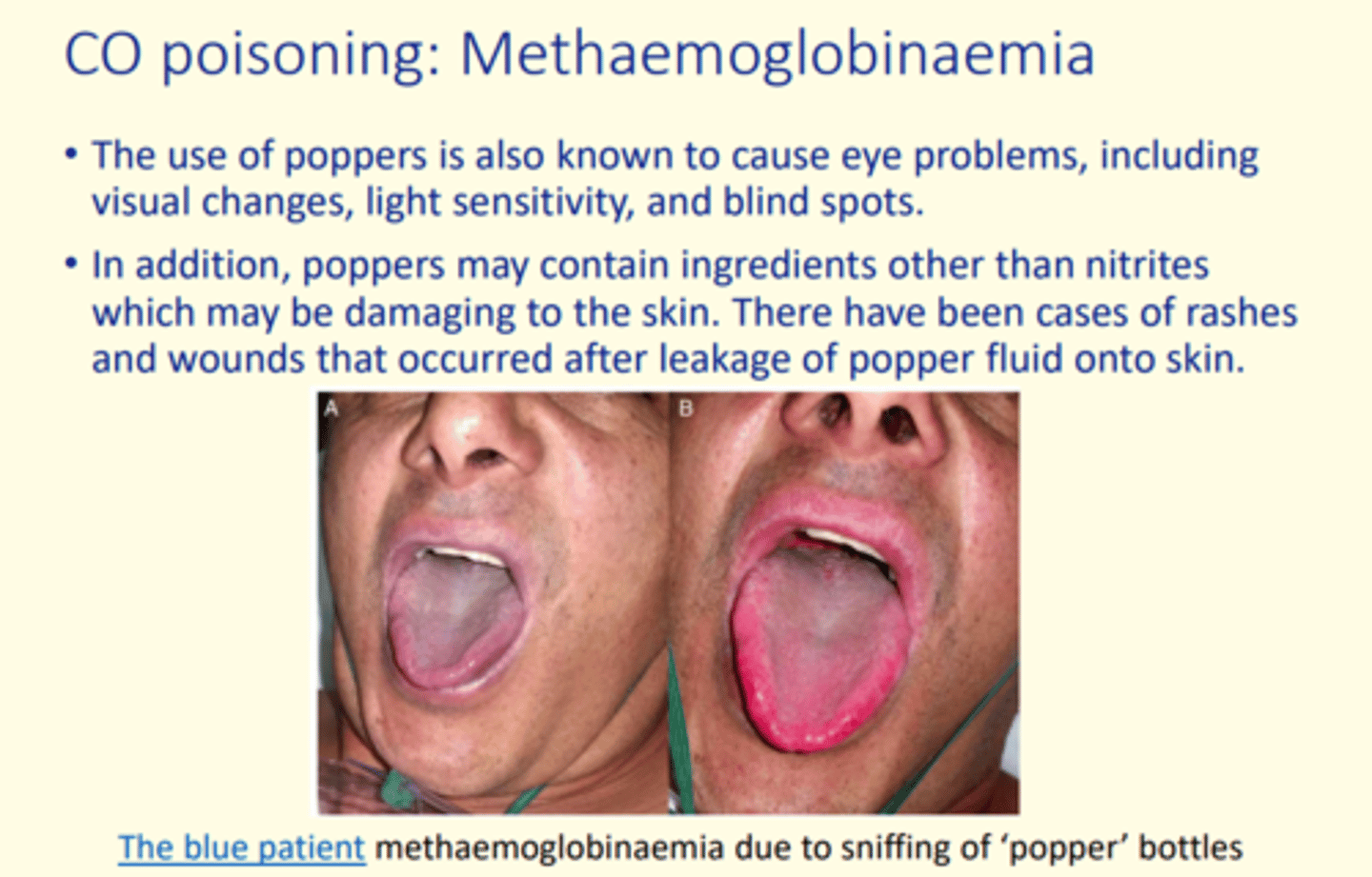 <p>methaemoglobinaemia</p>