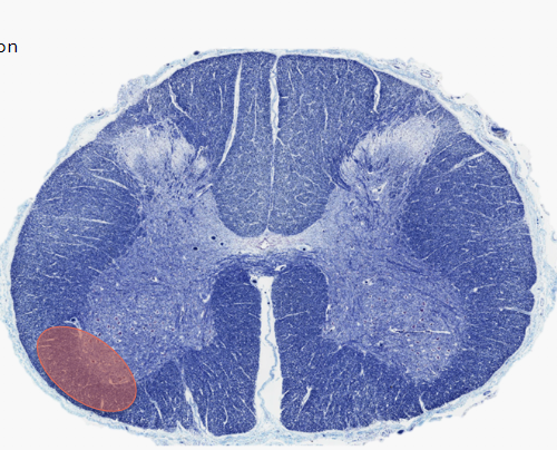 <p>What would be the major deficit of the lesion indicated?</p>