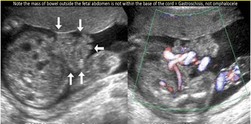 <p>an abd wall abn that occurs w/abd contents <strong>herniating through abd wall </strong>layers outside the fetus is </p><p>a) allantoic cyst</p><p>b) omphalocele</p><p>c) gastroschisis</p><p>d) cloacal extrophy</p>