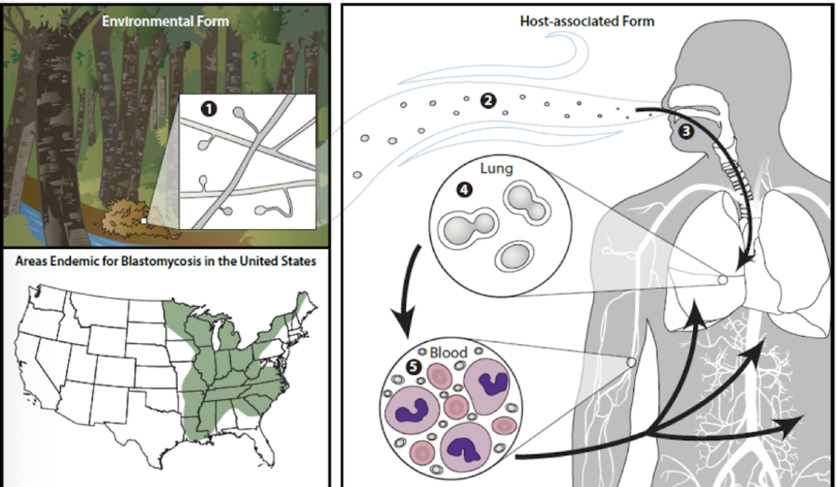 <p>Which fungus is transmitted by <strong>inhalation </strong>of <strong>decaying wood and soil </strong>and causes <strong><span>blastomycosis</span> </strong>in <strong>South Central and Southeastern US</strong>?</p><ul><li><p>flu-like symptoms, possible dissemination to skin, bones, joints</p></li></ul>
