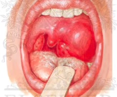 <p>accumulation of pus due to an infection behind one tonsil. Usually due to complication of untreated strep throat or tonsilitis.</p>