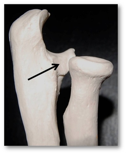 <p>proximal end of ulna on its lateral side (closest to radius)</p>