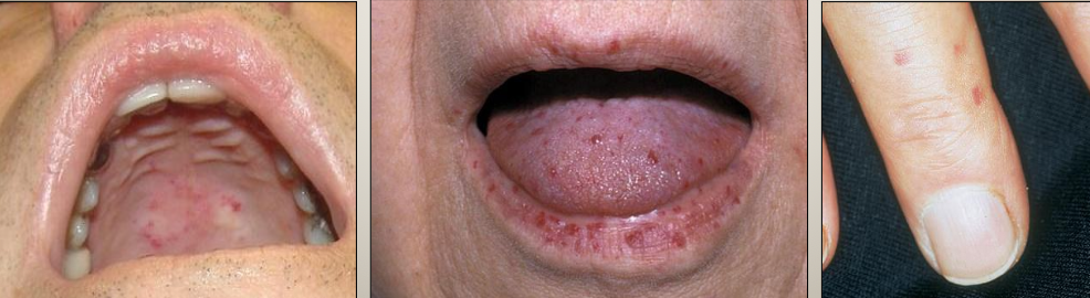 <p>What is Hereditary Hemorrhagic Telangiectasia (HHT)?</p>