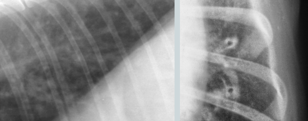 <p>What lung pattern? </p>