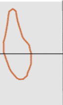 <p>what is this flow volume loop showing </p>