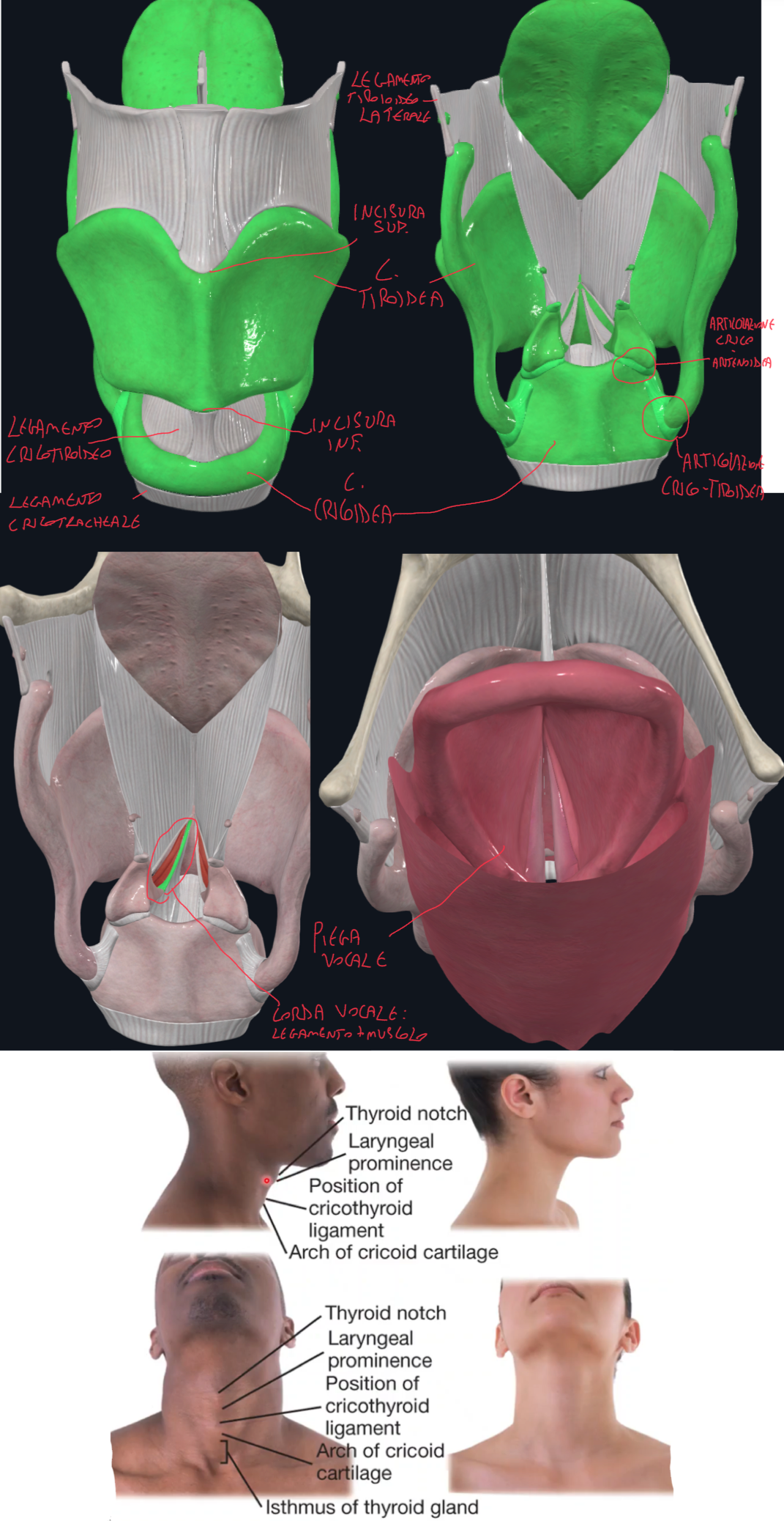<p>CARTILAGINE TIROIDEA:</p><ul><li><p>E’ la più voluminosa</p></li><li><p>Due lamine quadrangolari si uniscono anteriormente formando la Prominenza Laringea o Pomo d’Adamo (più acuto nell’uomo)</p></li><li><p>Superiormente e inferiormente abbiamo le rispettive Incisure Tiroidee</p></li><li><p>Posteriormente abbiamo i Corni superiori e inferiori:</p><ul><li><p>Su quelli superiori abbiamo il legamento tiroioideo laterale per l’osso ioide</p></li><li><p>Mentre su quelli inferiori abbiamo la superficie articolare con la cricoide → l’articolazione cricotiroidea permette l’inclinazione della cartilagine tiroidea rispetto la cricoide, importante per modulare la tensione delle corde vocali e quindi il tono della voce</p></li></ul></li><li><p>Membrana Tiroidea → sospende la laringe (cartilagine tiroidea) all’osso ioide</p></li><li><p>Corde Vocali → legamento + muscolo vocale (se aggiungiamo la mucosa parliamo di Piega Vocale)</p><ul><li><p>Dalla faccia interna della cartilagine tiroidea al processo vocale dell’aritenoide</p></li><li><p>Il legamento vocale rappresenta il margine superiore libero del cono elastico</p></li></ul></li></ul><p>CARTILAGINE CRICOIDEA:</p><ul><li><p>Forma di anello con castone, con la lamina posteriore più alta da cui avremo l’arco laterale e anteriore.</p></li><li><p>Sulla sua superficie laterale si articola il corno inferiore della tiroide, mentre sulla superficie superiore si articola con le aritenoidi</p></li><li><p>Legamento Cricotiroideo → anteriormente, unisce cricoide a tiroide</p></li><li><p>Legamento Cricotracheale → inferiormente, unisce cricoide a trachea</p></li></ul><p>Accessi di emergenza delle vie aeree:</p><ul><li><p>Cricotirotomia → incisione verticale cutanea + orizzontale del legamento cricotioideo.</p><ul><li><p>Rischio emorragico per lesione istmo tiroideo molto vascolarizzato presente sotto</p></li><li><p>Soluzione rapida e temporanea usata in emergenza</p></li></ul></li><li><p>Tracheostomia → preferita per un accesso definitivo, eseguita in ambiente chirurgico e con legatura dei vasi tiroidei</p></li><li><p>Sequenza palpabile: incisura tiroidea superiore → prominenza laringea → linea fusione lamine tiroidee → legamento cricotiroideo → anello cricoideo → anelli tracheali</p></li></ul><p></p>
