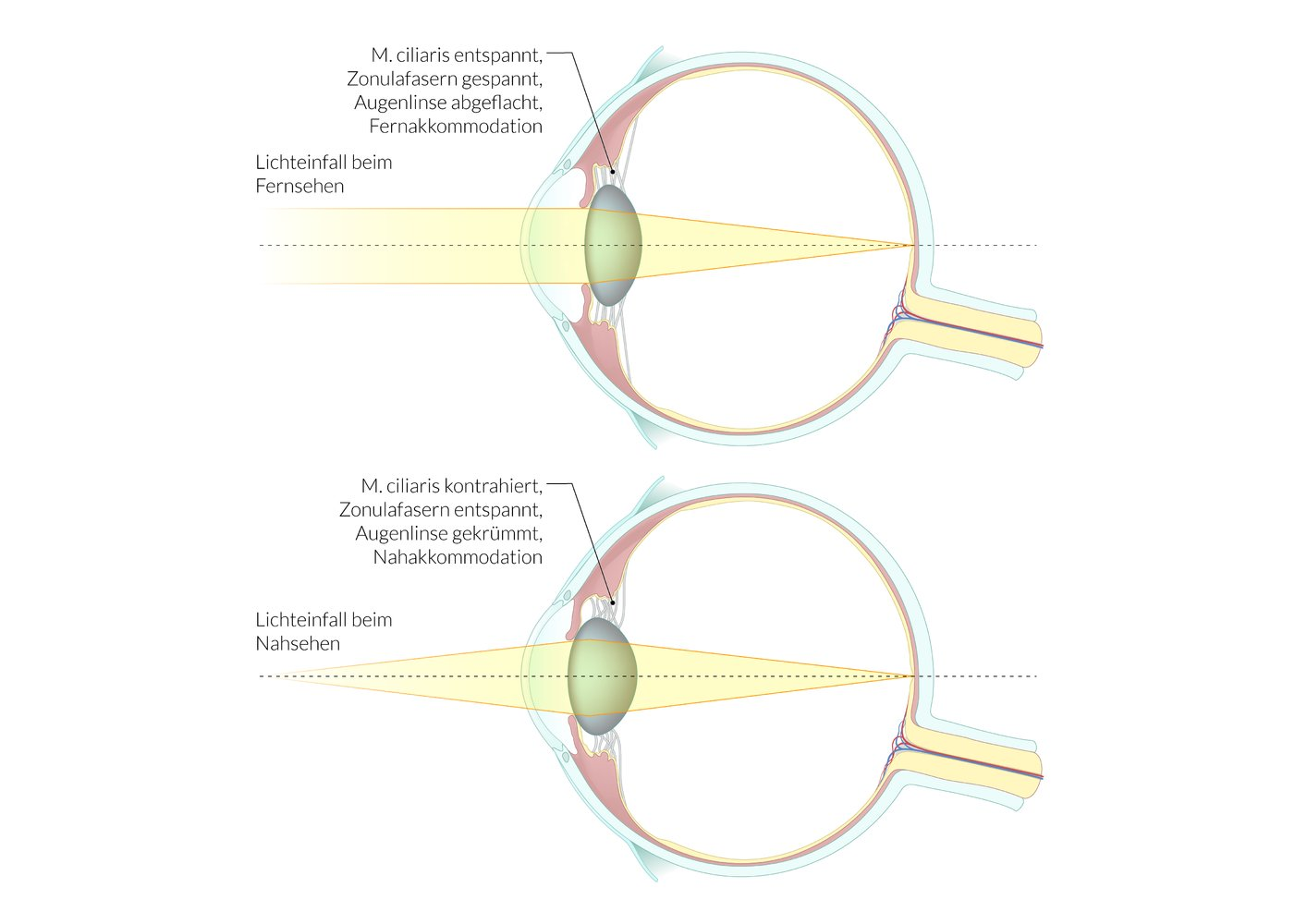 <p>E) Increase in the refractive power of the lens</p>