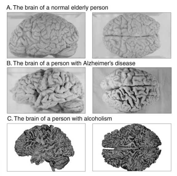 <p>Loss of brain tissue.</p>