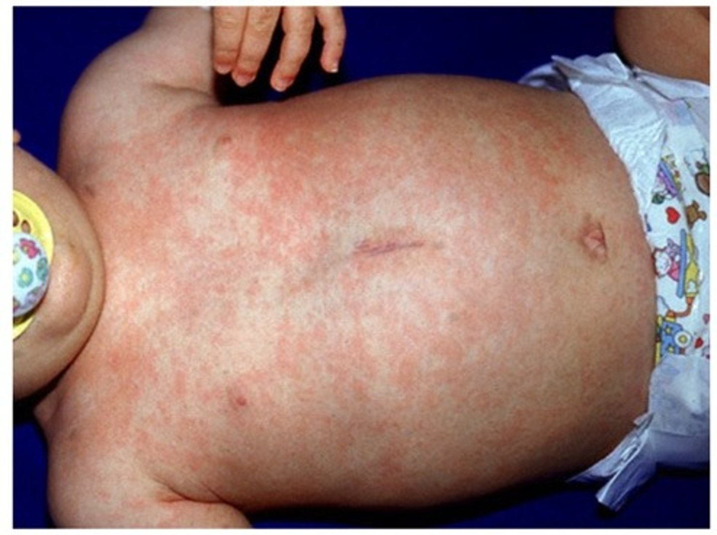<p>Etiology</p><p>-HHV6</p><p>Dx</p><p>-High fevers for 3 days followed by a Rash which starts at the Trunk then spreads to the Extremities but spares the Face (Only when pt is afebrile)</p><p>**Self-limiting**</p>