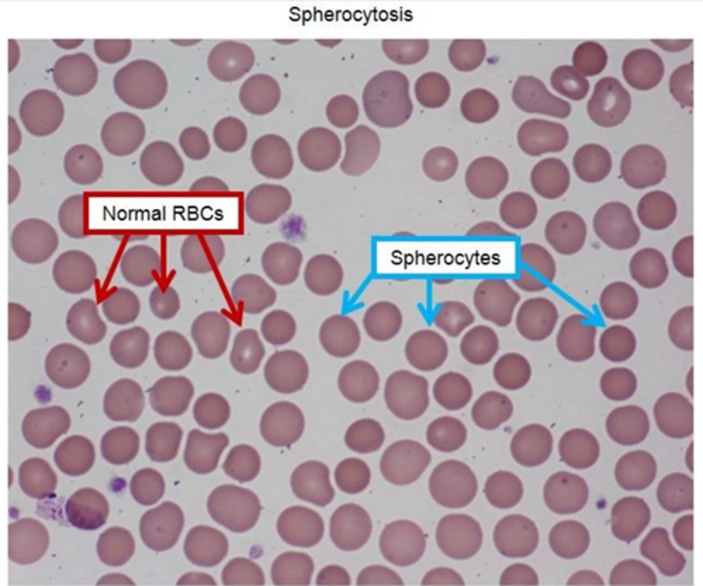 <p>-multiple small, round, dense and hyperchromic red blood cells without central pallor</p><p>-classic triad: hemolytic anemia, jaundice, splenomegly</p><p>-↑ MCHC</p><p>-↑osmofragility on acidified glycerol lysis test, abnormal eosin-5-maleimide binding test, negative coombs test</p><p>-Supportive treatment (folic acid supplementation, blood transfusions, splenectomy)</p><p>-complications include pigment gallstones, aplastic crises from parvovirus B19 infection</p>