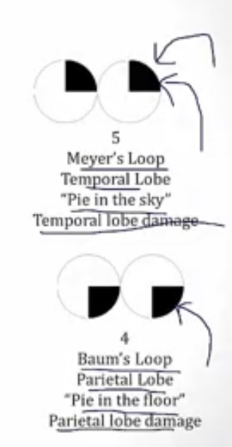 <p>-one quadrant of both visual fields is lost</p><p>-meyer’s; temporal; pie in the sky</p><p>-baum’s; parietal; pie in the floor</p>