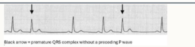 <ul><li><p>no preceding P wave or inappropriately placed P wave</p></li><li><p>QRS complex sooner than expected</p></li><li><p>pause following complex </p></li></ul><p></p>