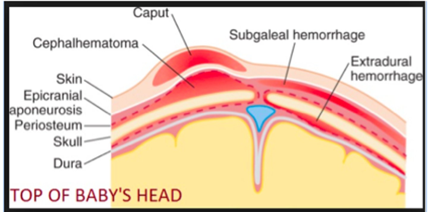 <p>bleeding between the epicranial aponeurosis of the scalp and the periosteum</p>