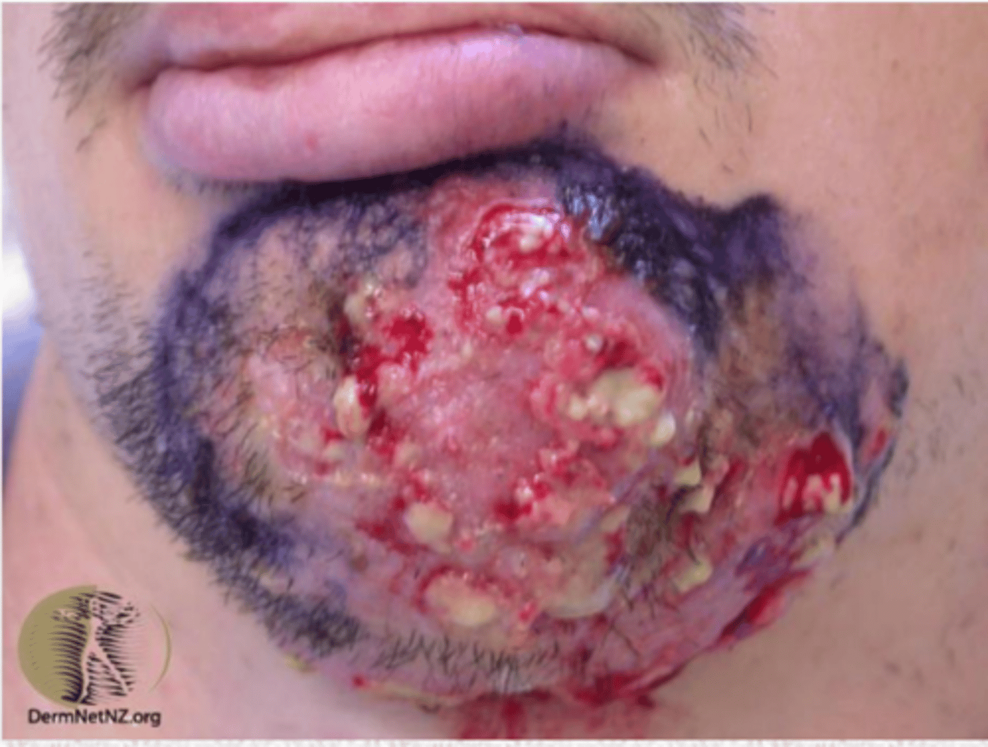 <p>Sycosis</p>