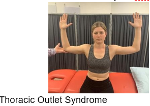 <ul><li><p>Assessment for: Thoracic Outlet Syndrome </p></li><li><p>arms to this position, open and closes hands for 3 minutes</p></li><li><p>Positive: ischemic pain/weakness/tingling</p></li></ul><p></p>