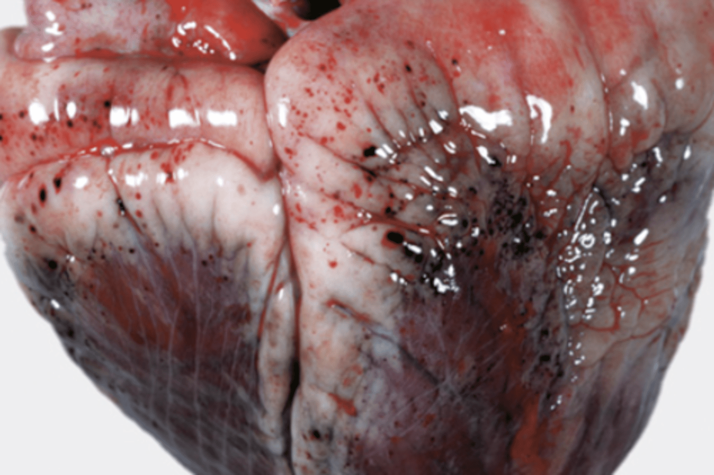 <p>This is a photo of hemorrhage. What type(s) of hemorrhages are seen?</p>