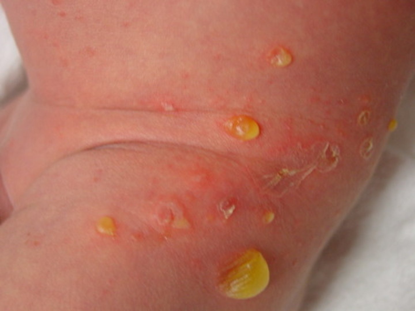 <p>blisters containing clear, yellow or slightly purulent fluid w/ an erythematous base</p>