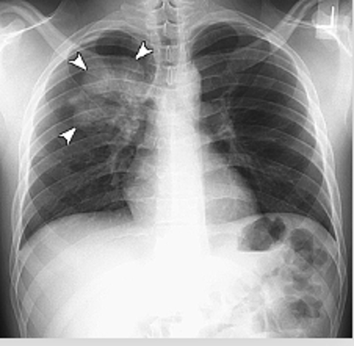 <p>Round pattern</p><p>oCan simulate a mass lesion such as a neoplasm.</p>