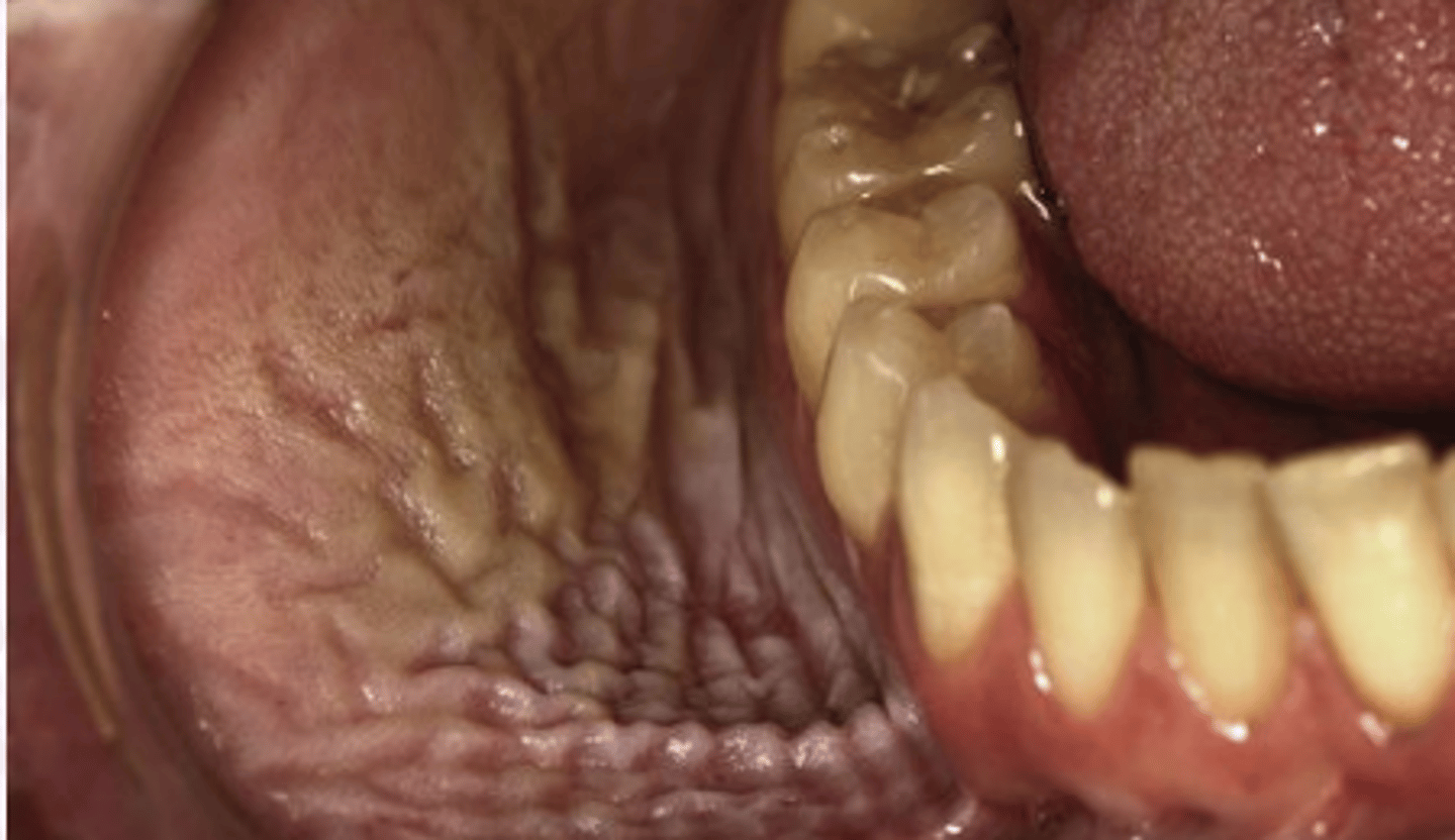 <p>Nicotine Stomatitis</p>