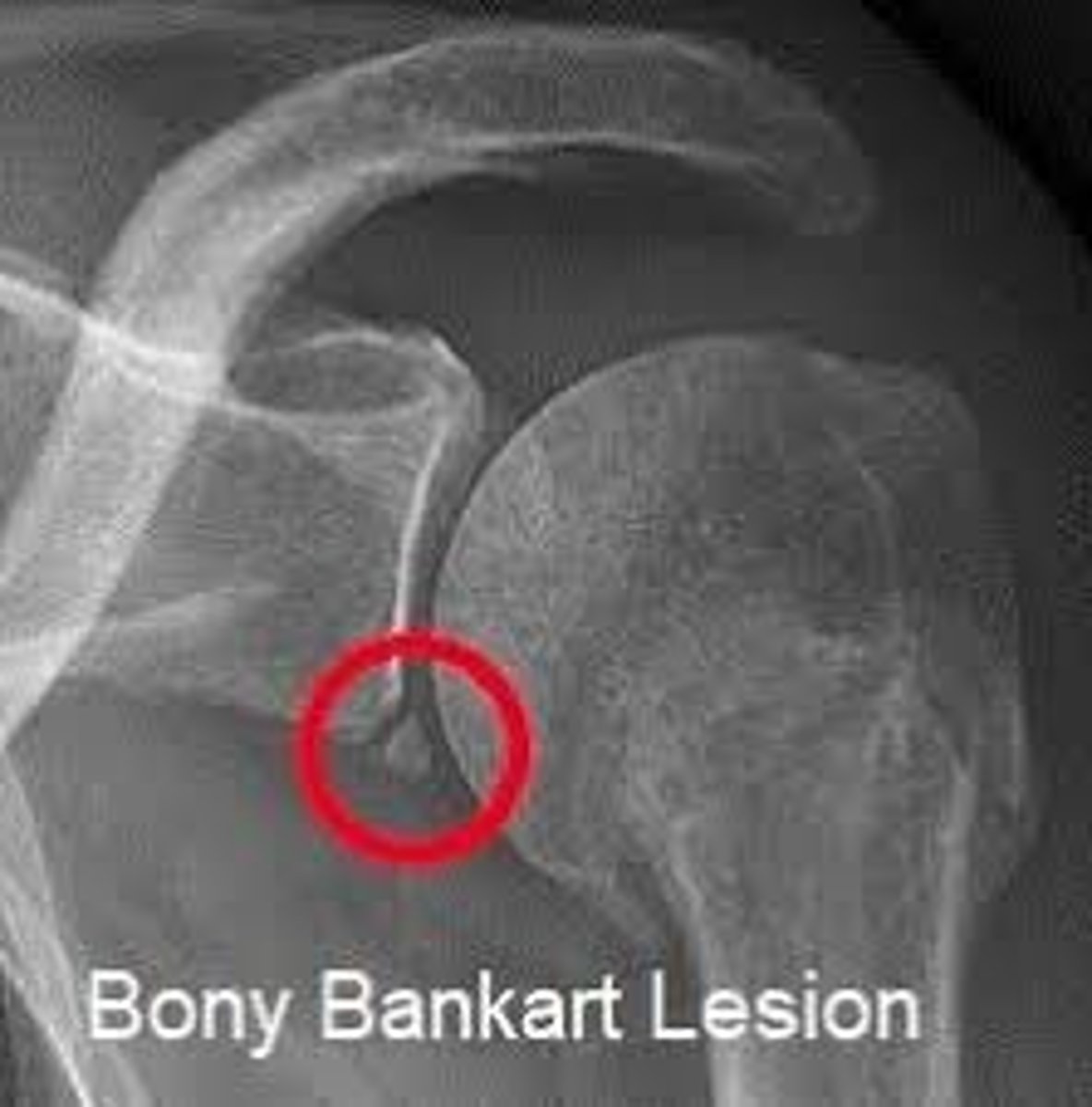 <p>a piece of the anterior inferior glenoid is fractured during anterior dislocation of shoulder</p>