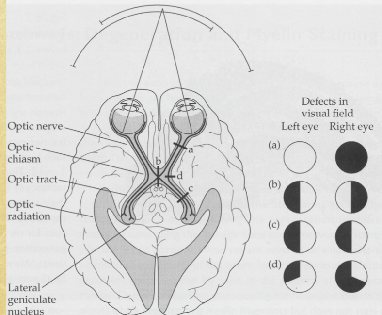 <p>left temporal retina + right nasal retina (right visual field)</p>