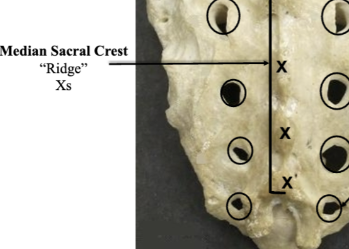 <p><strong>Median</strong> Sacral Crest</p>