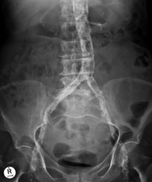 <p>tissue becomes hardened by deposition of calcium salts, which normally occurs in bone/teeth. from abnormal serum Ca or P levels in trophic tissues. conditions a/w these: chronic kidney failure, hyperparathyroidism, selected neoplasms, hypervitaminosis D</p>