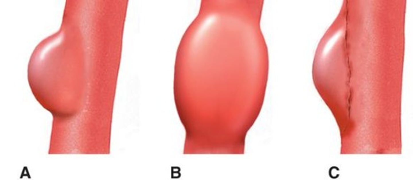 <p>A localized bulge/dilation in a blood vessel due to wall weakness.</p>