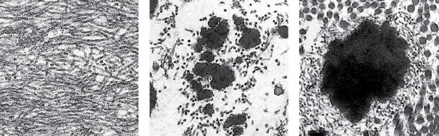 <p>They are <span><span>composed of </span><strong><span>fibrillin </span></strong><span>(350 kDa), which forms a network of </span><strong><span>microfibrils</span></strong><span>, embedded in a larger mass of cross- linked </span><strong><span>elastin </span></strong><span>(60 kDa). Both proteins emerge by secretion from fibroblasts (and smooth muscle cells in vascular walls) and give rise to elastic fibers in a stepwise manner as shown in Figure 5–14. Initially, microfibrils with diameters of 10 nm develop from fibrillin and various glycoproteins. The microfibrils act as scaffolding upon which elastin is then deposited. Elastin accumulates around the microfibrils, eventually making up most of the elastic fiber, and conferring the rubberlike property.</span></span></p>
