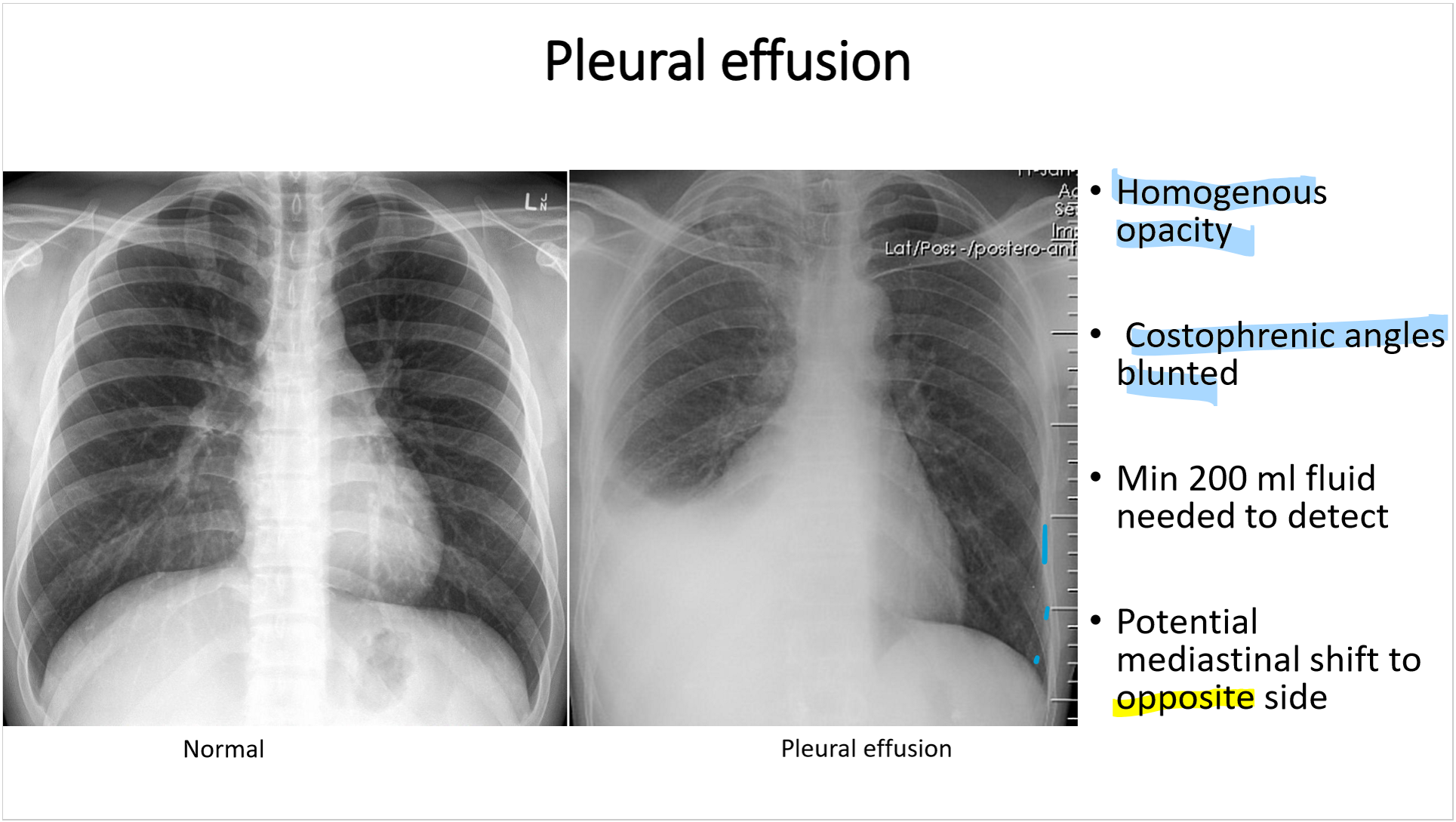 <p>pleural effusion:</p><ol><li><p><strong>homogenous </strong>opacity</p></li><li><p>blunted <strong>costophrenic angles (bc </strong></p></li><li><p>min of<strong> 200 ml </strong>fluid needed detect</p></li><li><p>potential mediastinal shift to <strong>OPPOSITE </strong>side</p></li></ol><p></p>