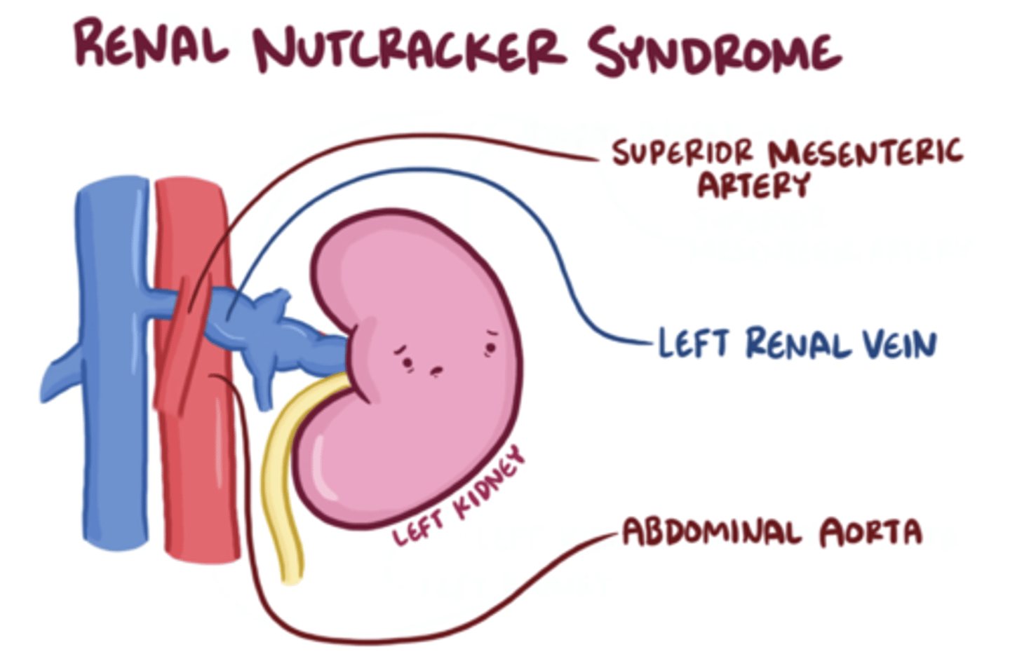 <p>left renal vein is compressed between the SMA and the abdominal aorta.</p><p>Consequences include:Impaired blood drainage from the left kidney.Increased pressure in the left renal vein, which can cause:Hematuria (blood in urine).Left flank pain.Varicoceles (swelling of veins in the scrotum in males, due to impaired venous return).</p>