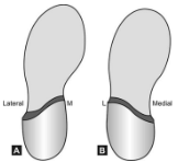 <p>Name this orthosis. What is the difference between A and B?</p>