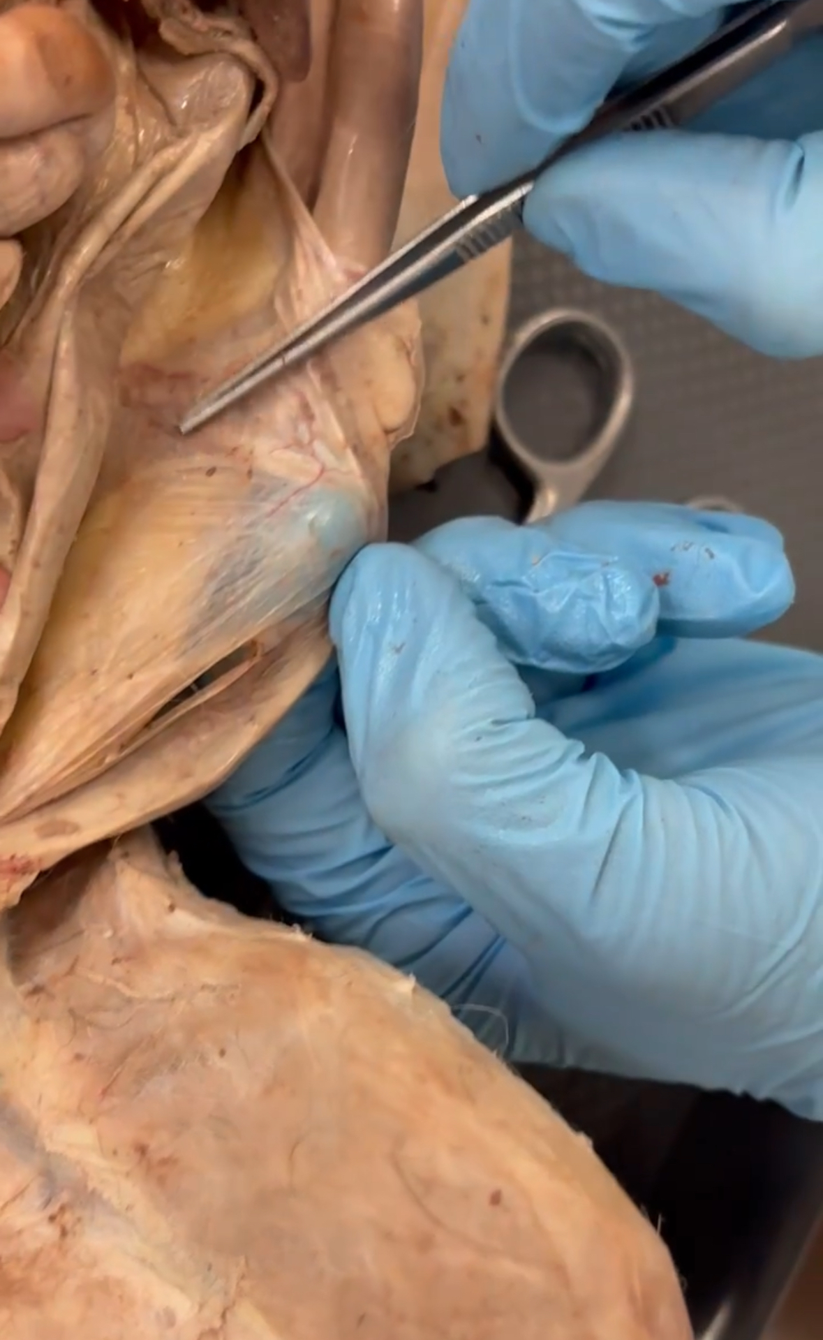 <p>Pointer points to which ligament</p>