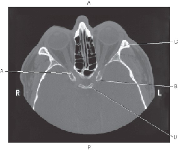 <p>Which line points to the zygoma?</p>