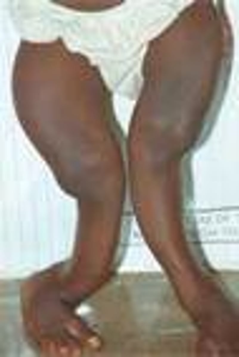 <p>A bone weakness disease caused by vitamin D deficiency.</p>