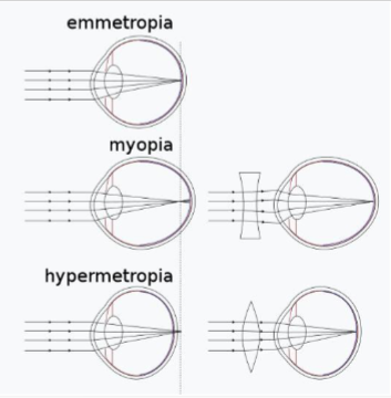 <ul><li><p>emmetropia- normal vision</p></li><li><p>myopia- image is formed in front of the retina; “nearsighted”</p></li><li><p>hyperopia (hypermetropia)- image is focused behind the retina; “farsighted”</p></li><li><p>astigmatism- irregular curvature of the cornea or lens</p></li></ul><p></p>